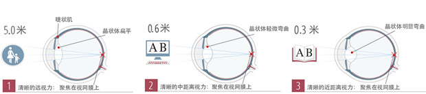 你是老花眼吗?老花眼症状、形成和治疗