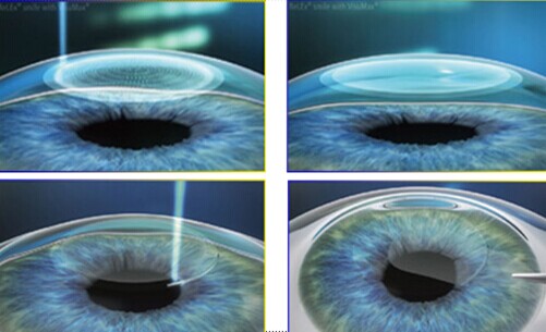 微创、无瓣”全飞秒”激光系统  革新近视手术技术