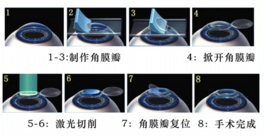 微创、无瓣”全飞秒”激光系统  革新近视手术技术