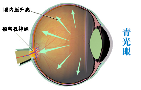 青光眼眼压是怎么升高的?