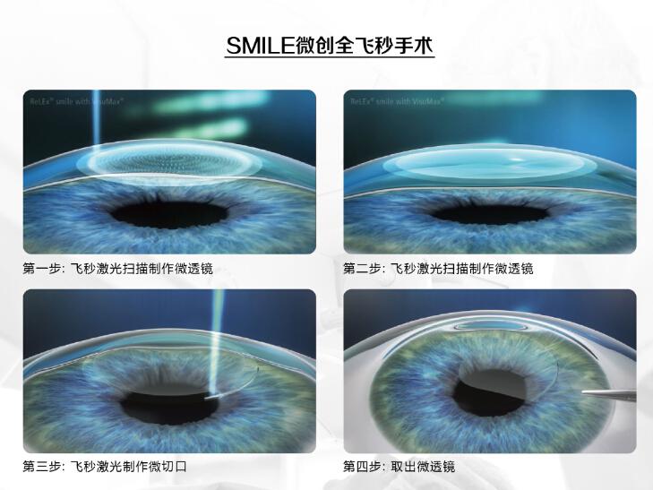 蔡司半飞秒近视手术与极速宇航飞秒有什么区别?