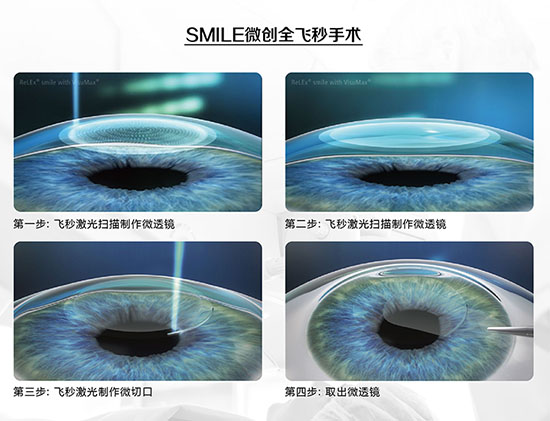 TransPRK与全飞秒激光近视手术哪个好?