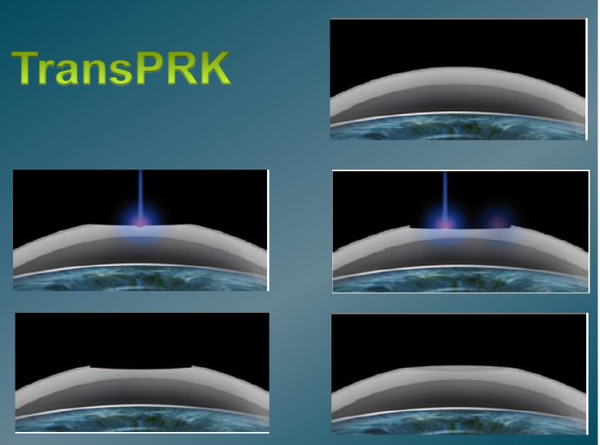 TransPRK手术与蔡司全飞秒手术、宇航半飞秒手术有什么区别?