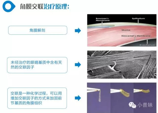 【直播】周继容主刀角膜交联术