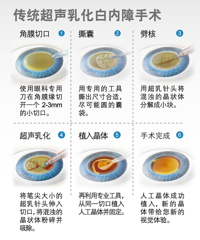 飞秒白内障和传统白内障手术的区别
