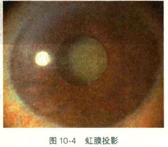 普瑞专家说｜白内障分型之——皮质性白内障