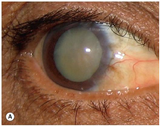 普瑞专家说｜白内障分型之——皮质性白内障