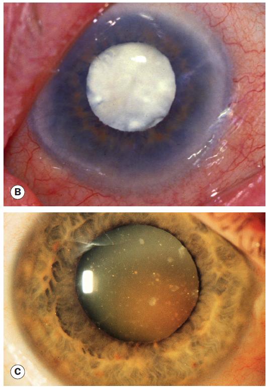 普瑞专家说｜白内障分型之——皮质性白内障